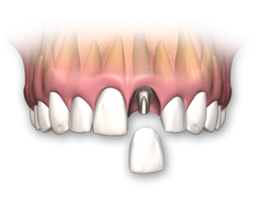implant-dentar-un-singur-dinte