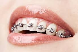 aparat dentar ortodontie