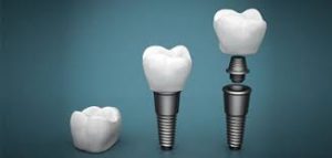 tratament implant dentar